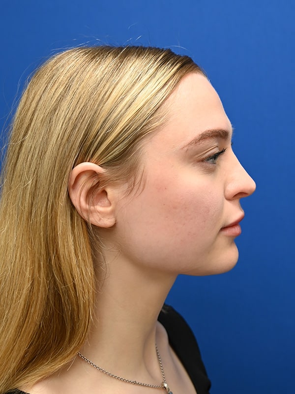 Rhinoplasty Before & After Image