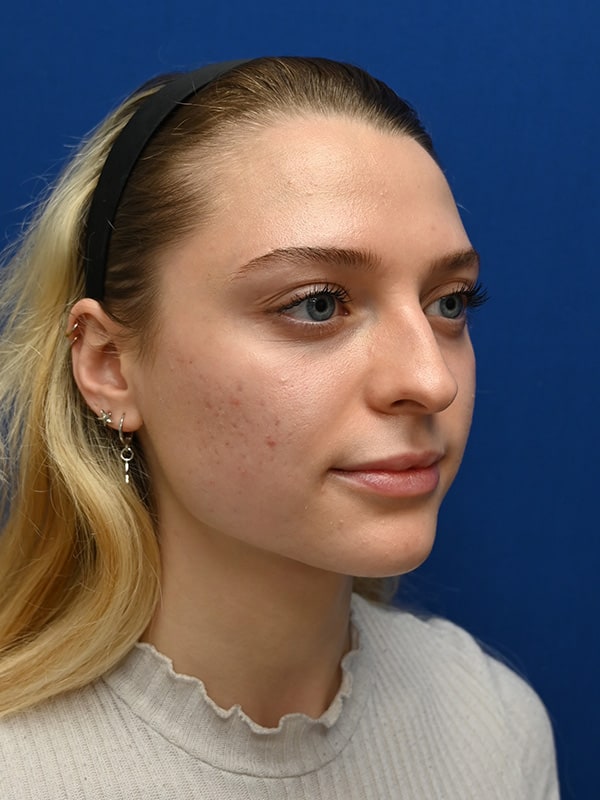 Rhinoplasty Before & After Image