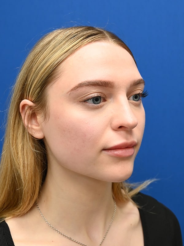 Rhinoplasty Before & After Image