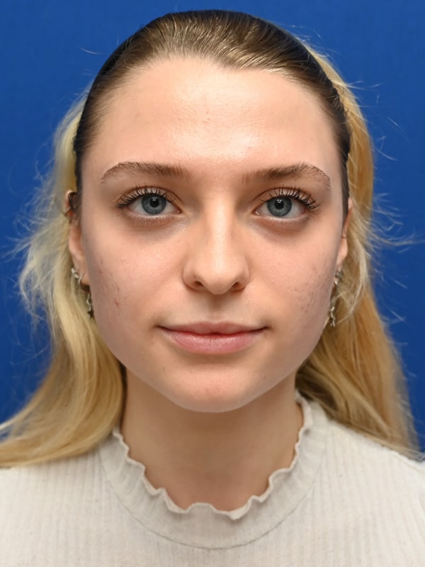 Rhinoplasty Before & After Image