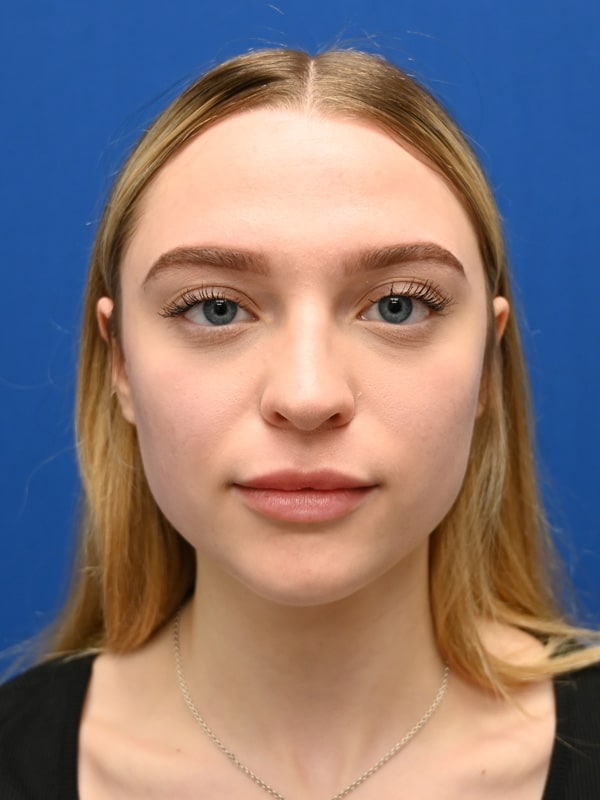 Rhinoplasty Before & After Image