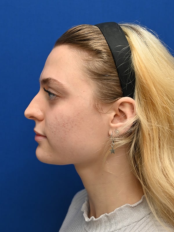 Rhinoplasty Before & After Image