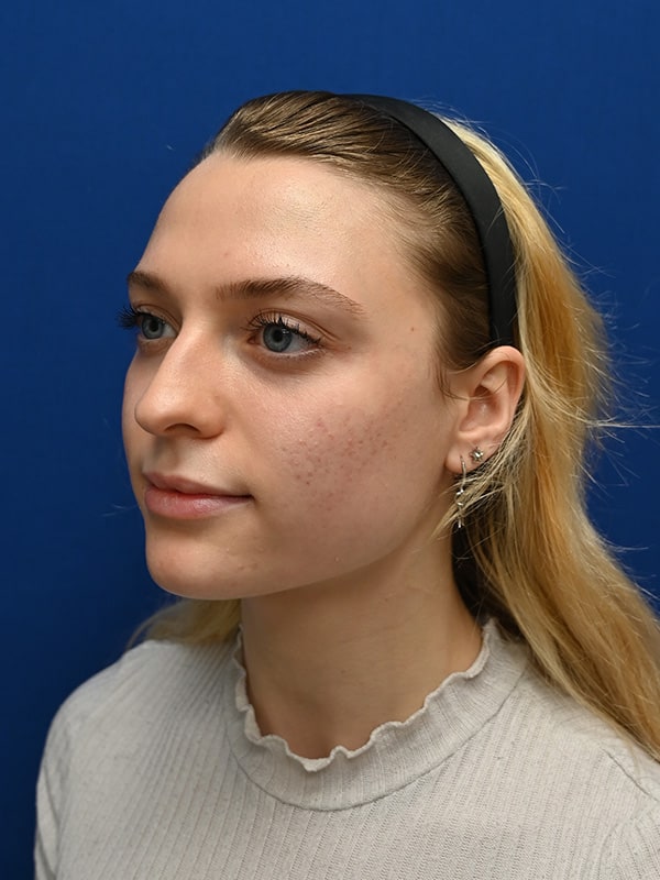 Rhinoplasty Before & After Image