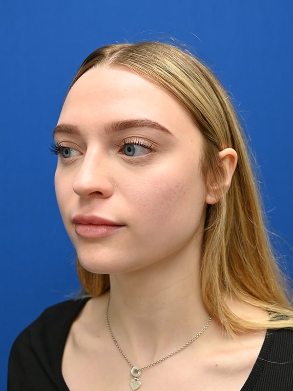 Rhinoplasty Before & After Image