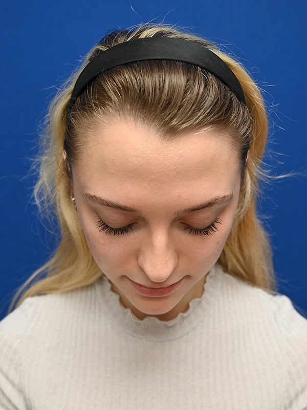 Rhinoplasty Before & After Image