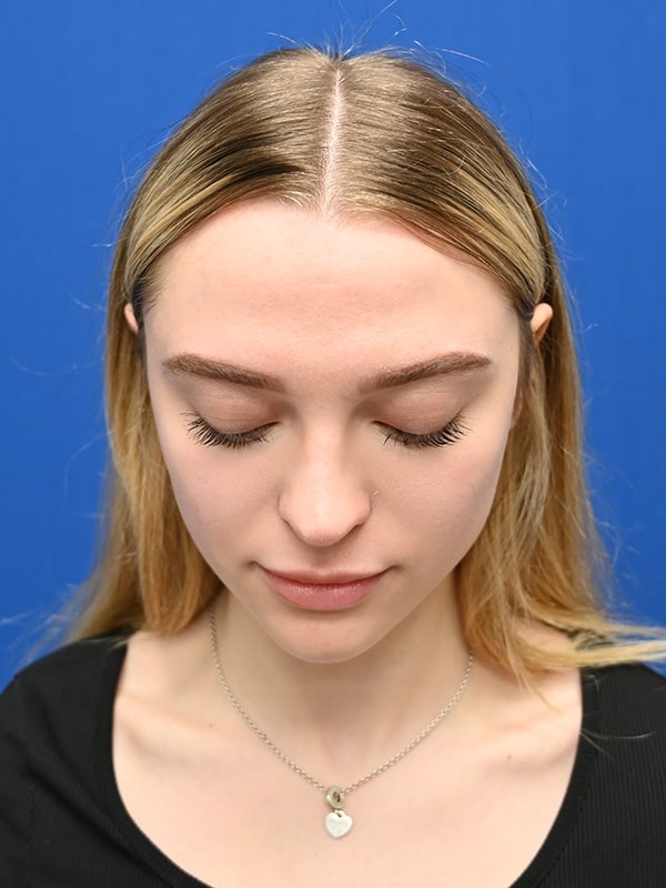 Rhinoplasty Before & After Image
