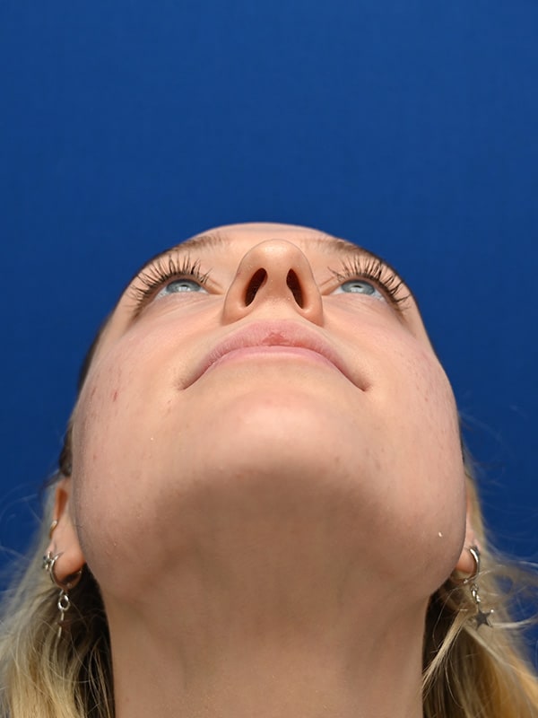 Rhinoplasty Before & After Image