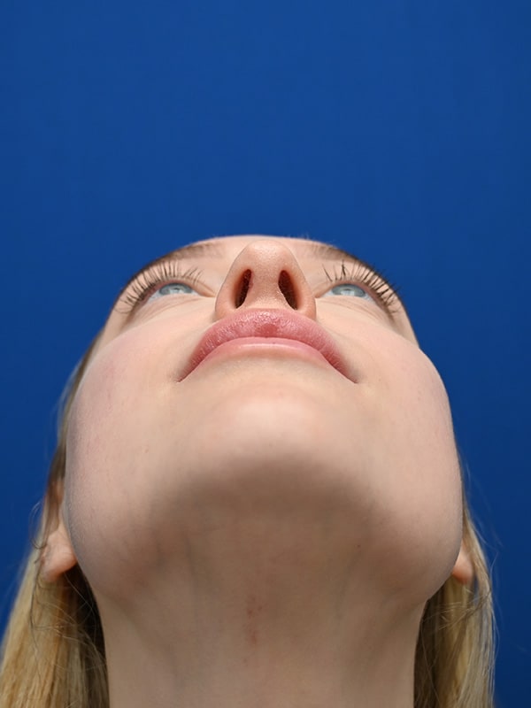 Rhinoplasty Before & After Image