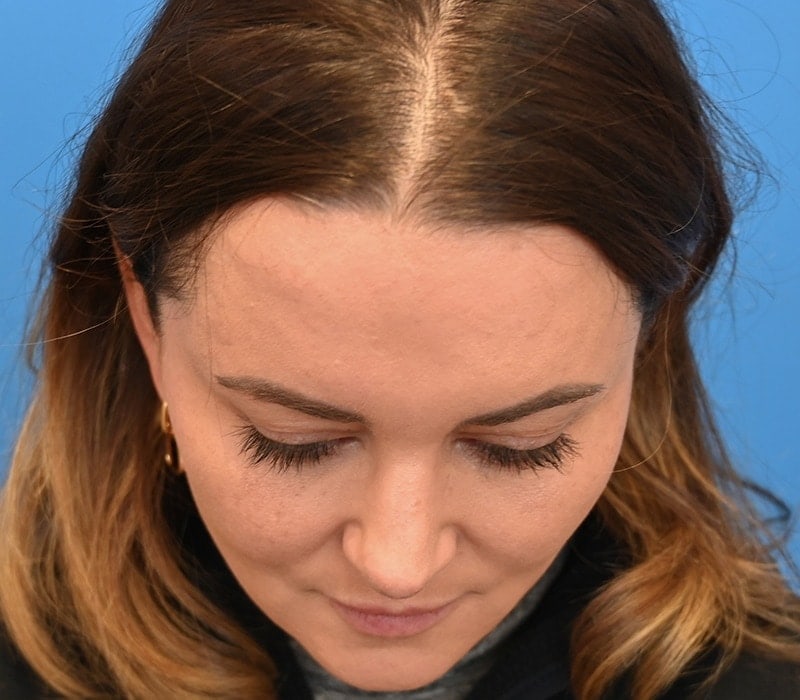 Rhinoplasty Before & After Image