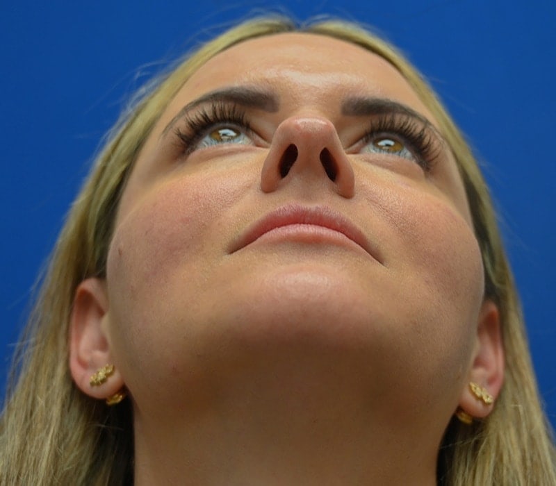 Rhinoplasty Before & After Image