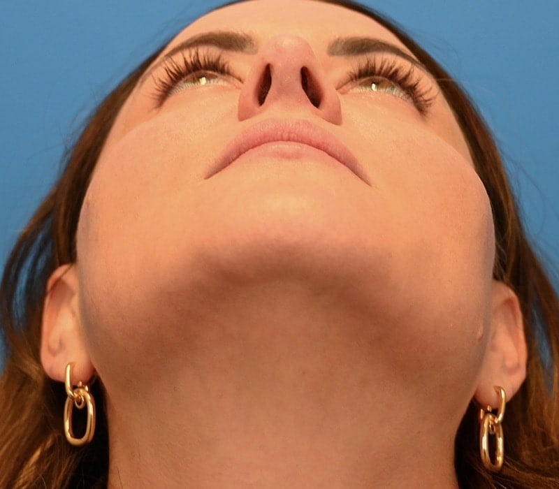 Rhinoplasty Before & After Image