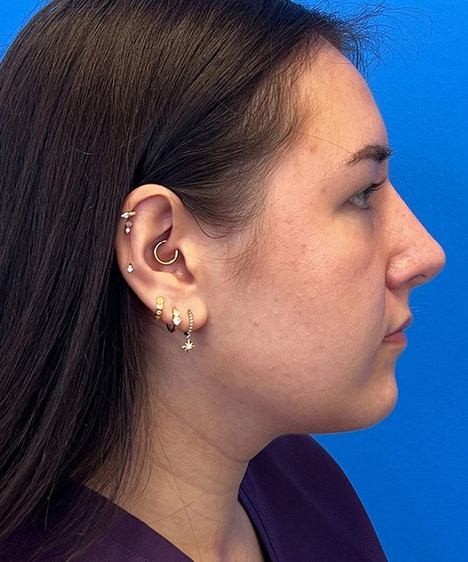 Rhinoplasty Before & After Image