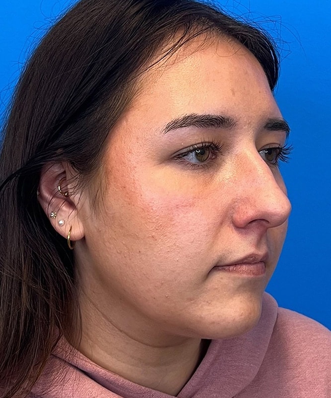 Rhinoplasty Before & After Image
