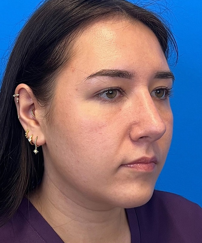 Rhinoplasty Before & After Image