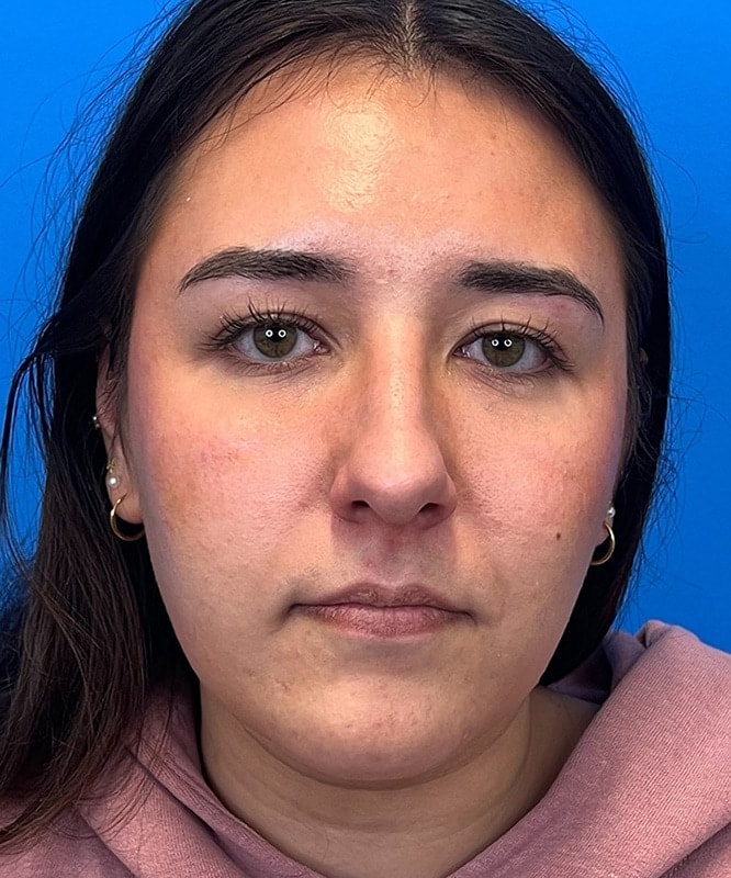 Rhinoplasty Before & After Image