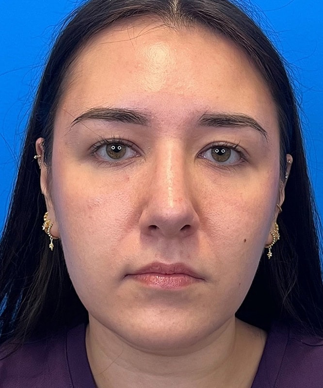 Rhinoplasty Before & After Image