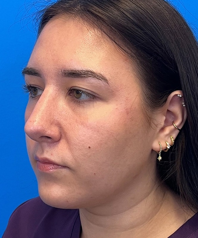 Rhinoplasty Before & After Image