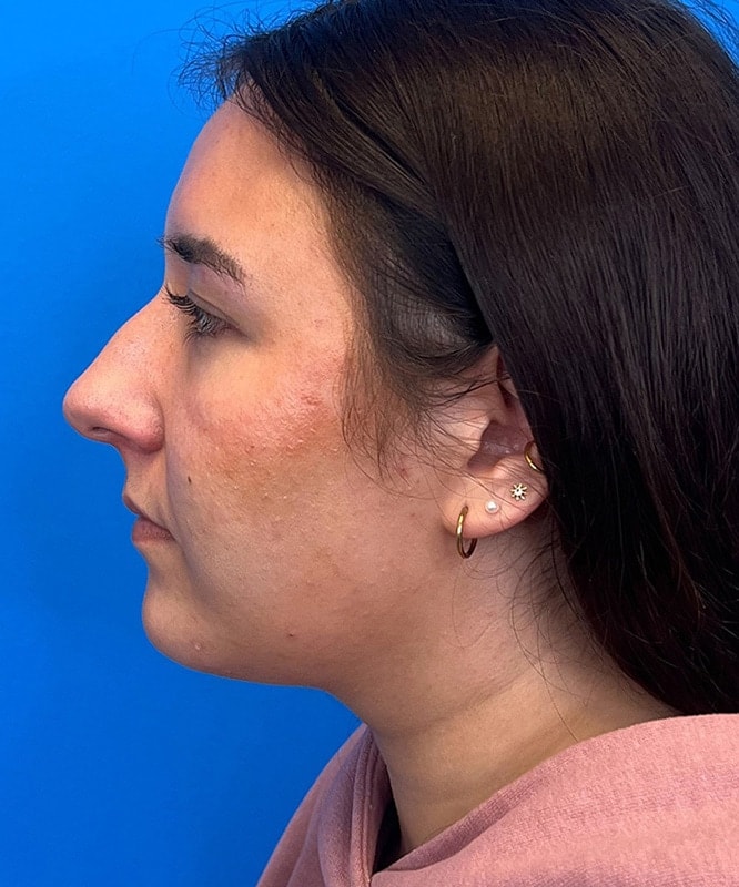 Rhinoplasty Before & After Image