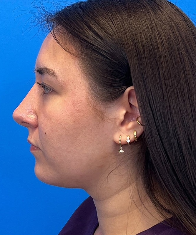 Rhinoplasty Before & After Image