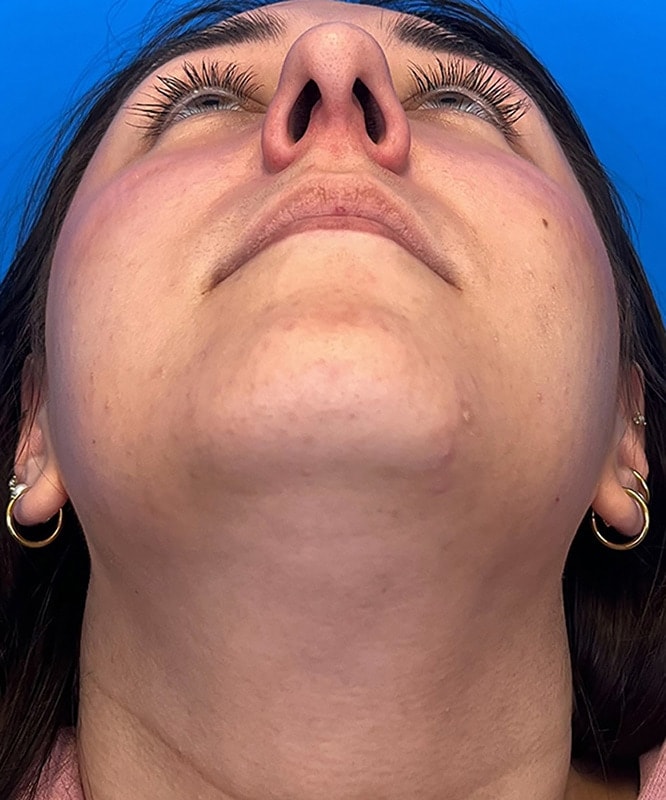 Rhinoplasty Before & After Image
