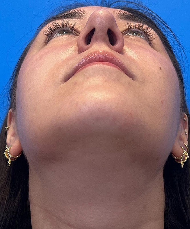 Rhinoplasty Before & After Image