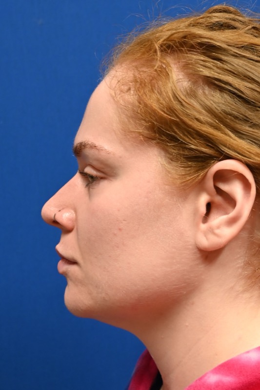 Rhinoplasty Before & After Image