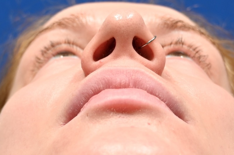 Rhinoplasty Before & After Image