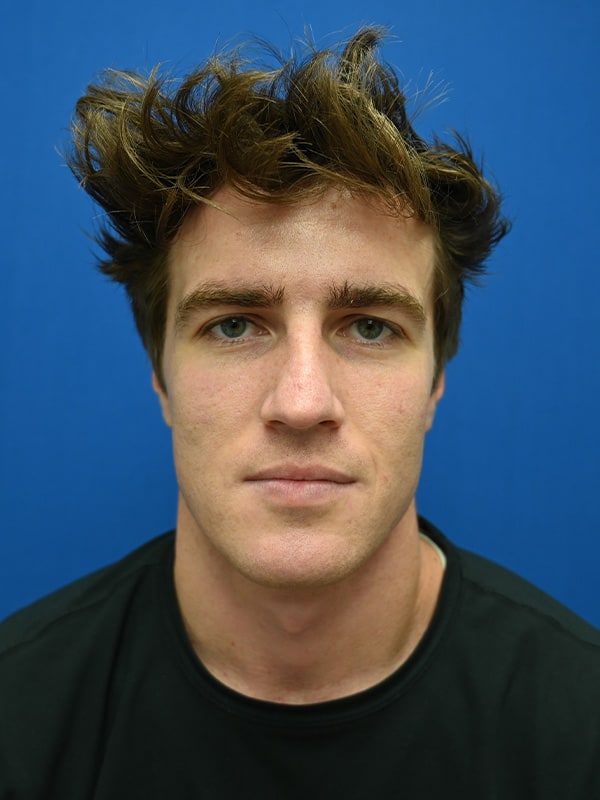 Rhinoplasty Before & After Image