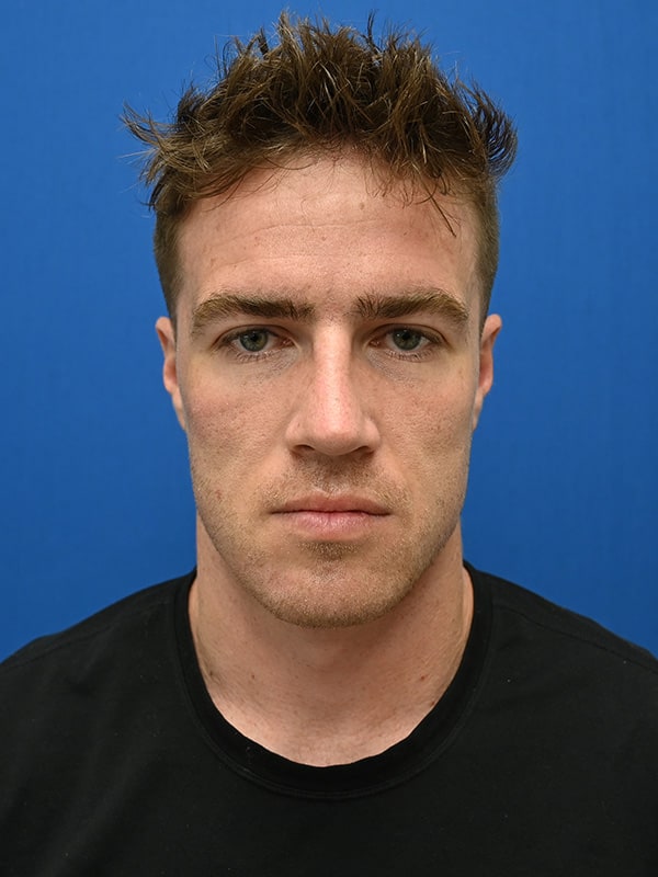 Rhinoplasty Before & After Image