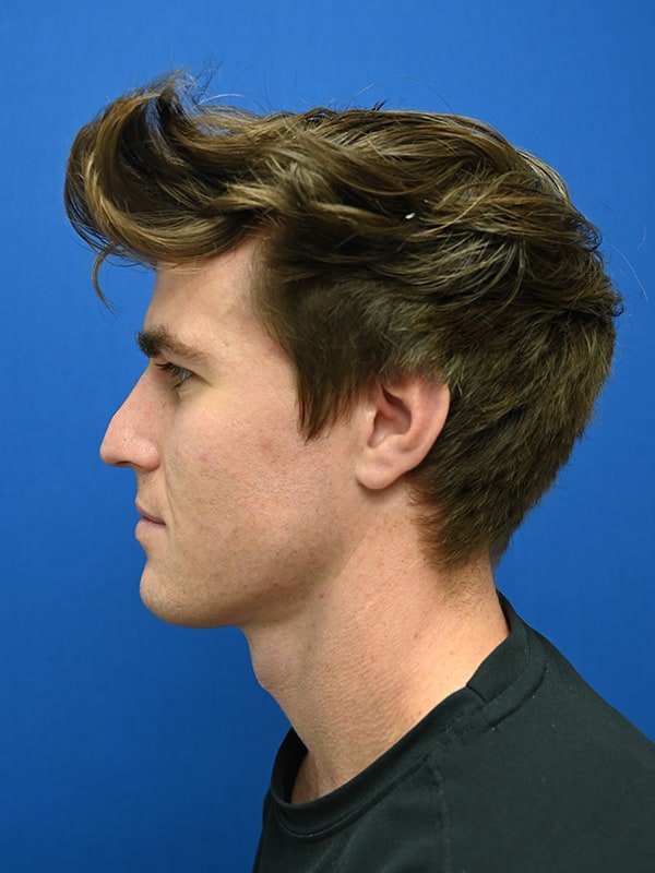 Rhinoplasty Before & After Image