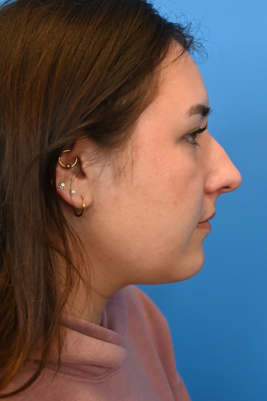 Rhinoplasty Before & After Image