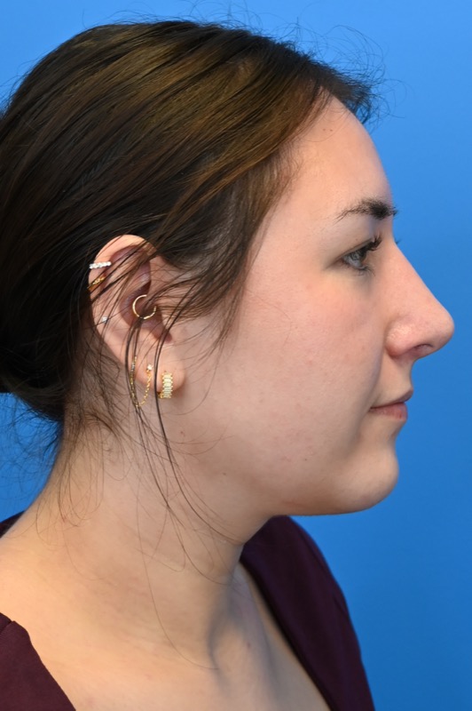 Rhinoplasty Before & After Image