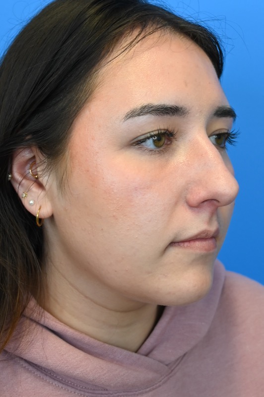 Rhinoplasty Before & After Image