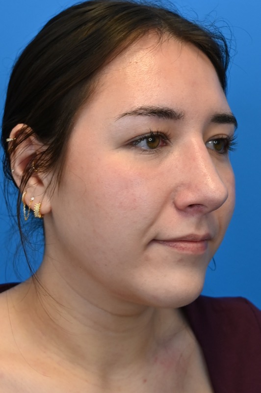 Rhinoplasty Before & After Image