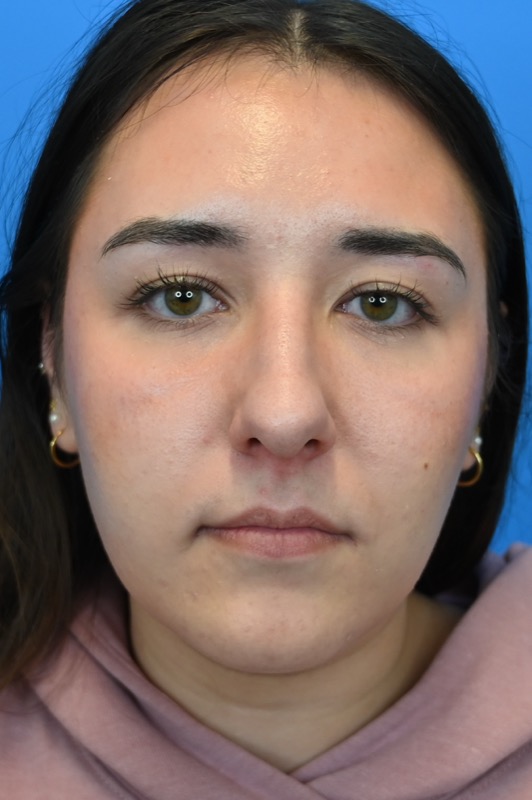 Rhinoplasty Before & After Image