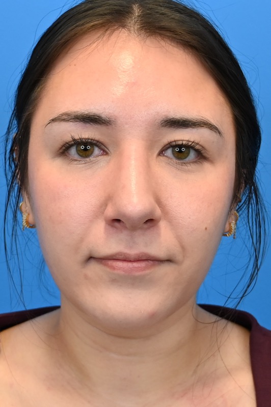 Rhinoplasty Before & After Image