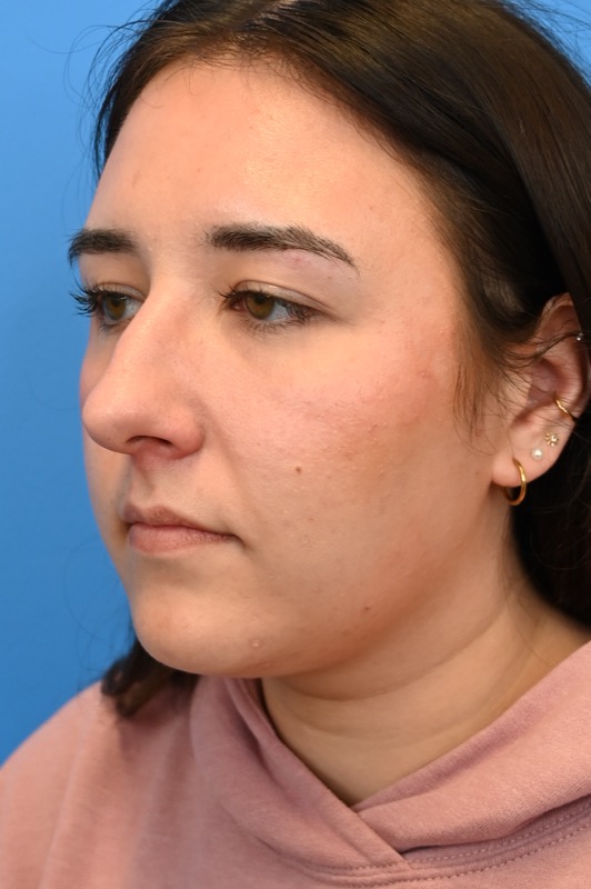 Rhinoplasty Before & After Image