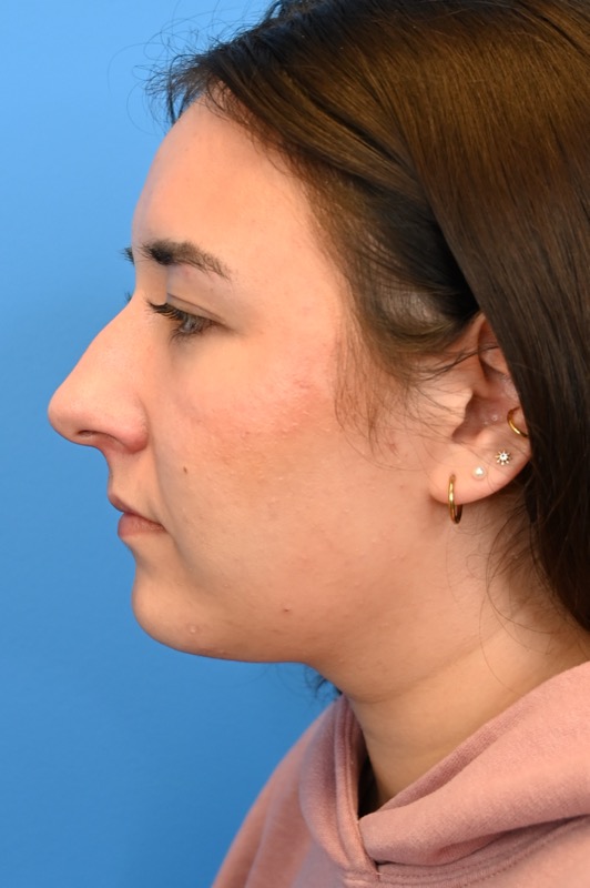 Rhinoplasty Before & After Image