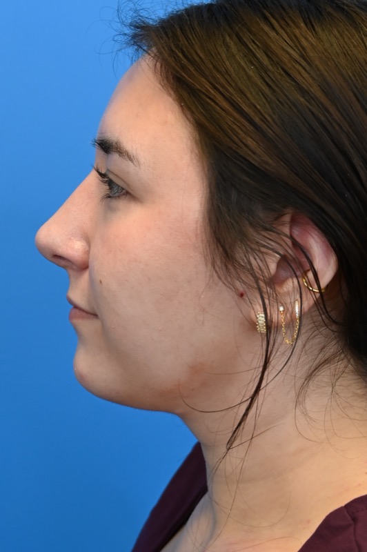 Rhinoplasty Before & After Image