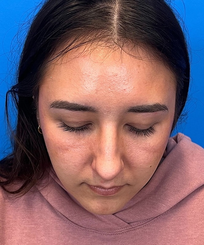 Rhinoplasty Before & After Image