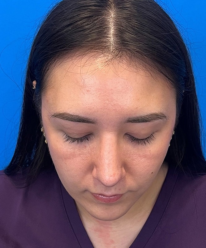 Rhinoplasty Before & After Image