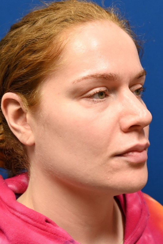 Rhinoplasty Before & After Image