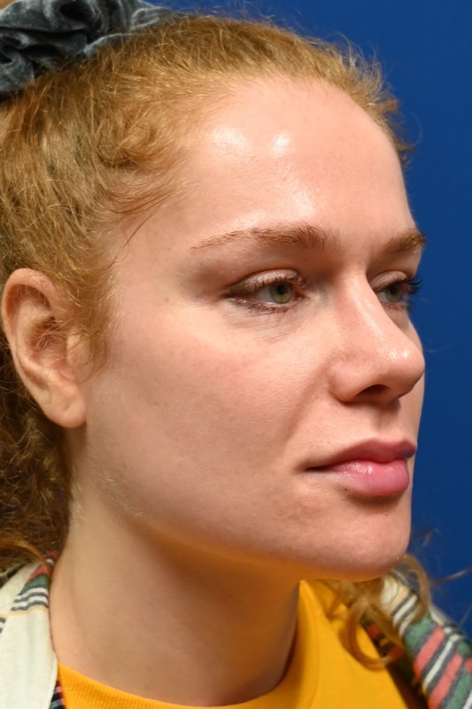 Rhinoplasty Before & After Image