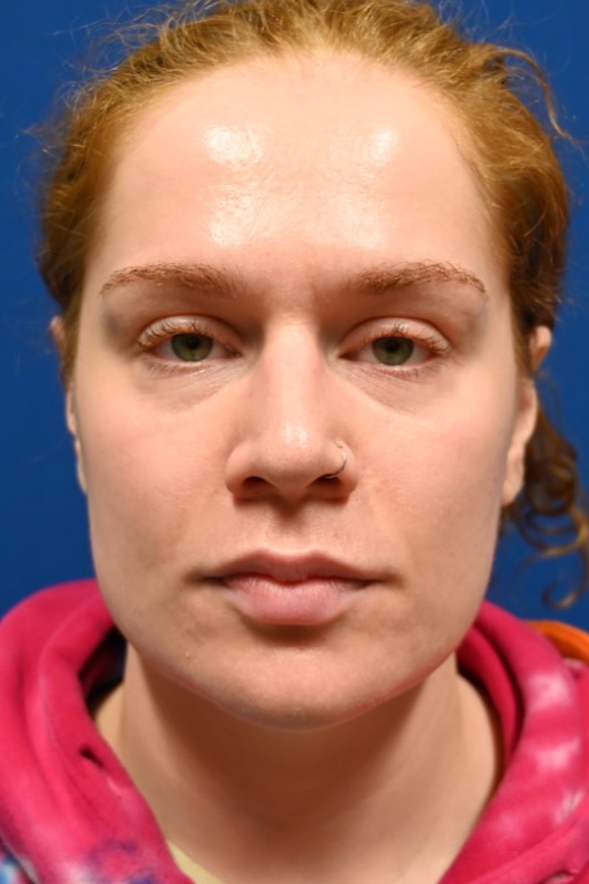 Rhinoplasty Before & After Image