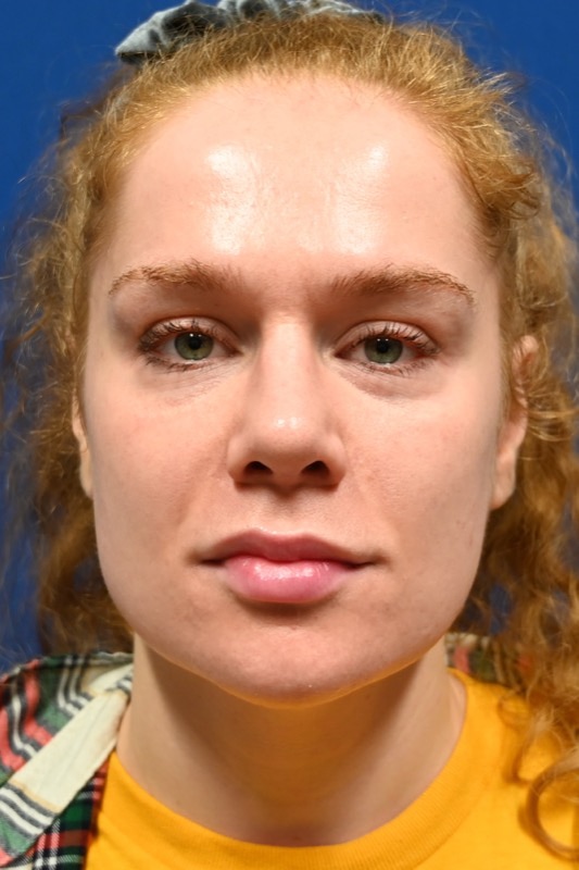 Rhinoplasty Before & After Image