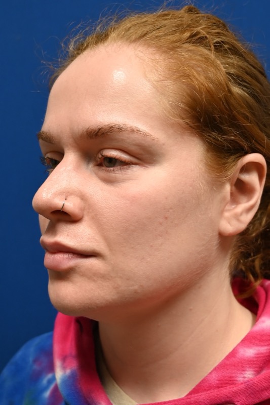 Rhinoplasty Before & After Image