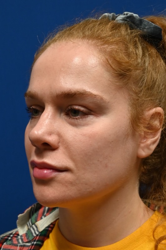 Rhinoplasty Before & After Image