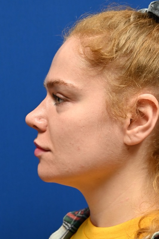 Rhinoplasty Before & After Image