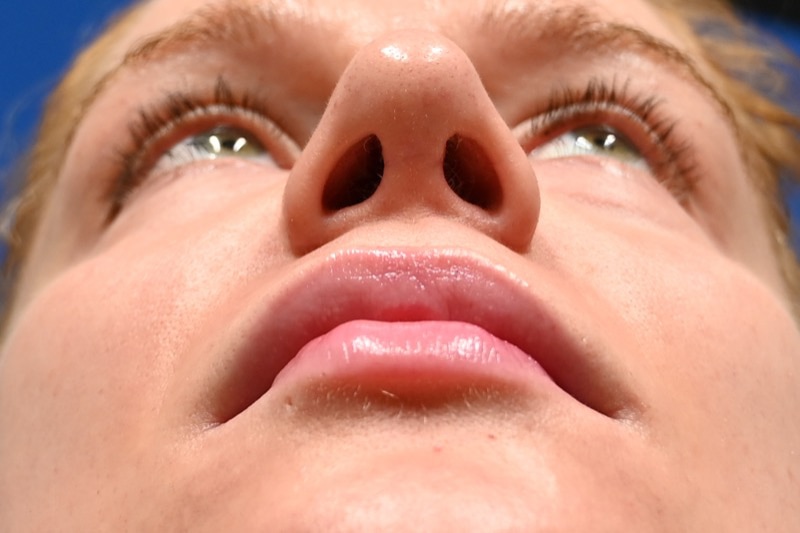 Rhinoplasty Before & After Image