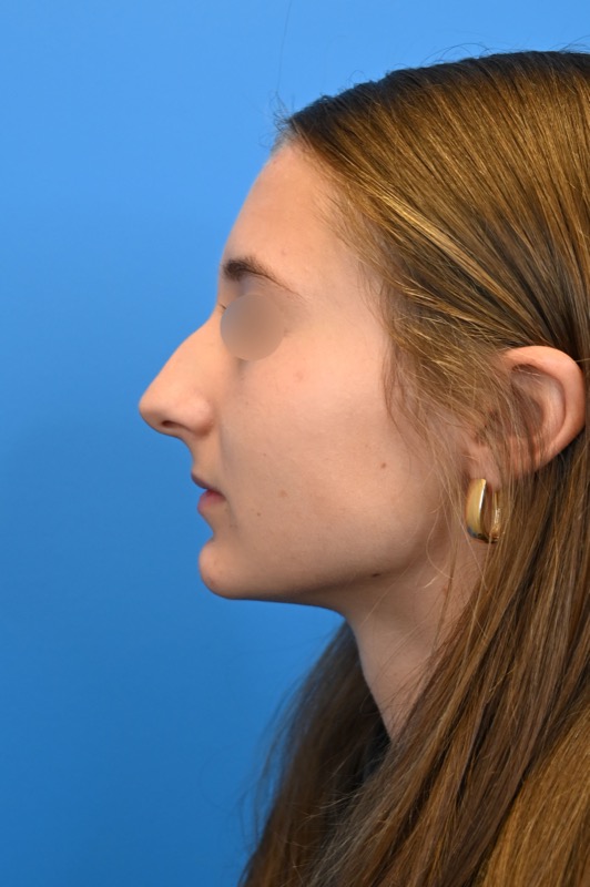 Rhinoplasty Before & After Image